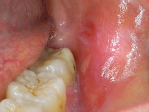 20_金属アレルギー_IntraOral_20111221201252-1